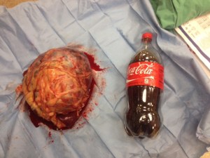 Sheila's nearly 9 pound abdominal tumor! That is a 2 liter bottle of Coke for size comparison!!